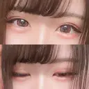 二重埋没 / ヒアルロン酸注入（涙袋） ルラ美容クリニック 新宿院 AFTER サムネイル用