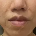 人中短縮 銀座アテナクリニック DAY 250 サムネイル用
