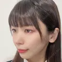 鼻尖形成（切開） / 鼻中隔延長（切開） / 軟骨移植 eクリニック 金沢本院 DAY 158 サムネイル用
