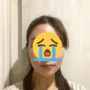 脂肪吸引（顔） ヴェルトラクリニック 大阪院 DAY 3 サムネイル用