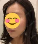 脂肪注入（輪郭） 湘南美容クリニック 新潟院 DAY 18 サムネイル用