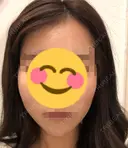 脂肪注入（輪郭） 湘南美容クリニック 新潟院 DAY 18 サムネイル用