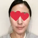 ハイフ（顔） 池袋麗歯科・美容皮膚科 DAY 0 サムネイル用