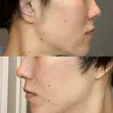 ダーマペン AURORA CLINIC（オーロラクリニック）新宿院 AFTER サムネイル用