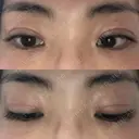 二重切開 松下皮フ形成外科 DAY 31 サムネイル用