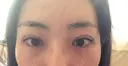二重切開 松下皮フ形成外科 DAY 31 サムネイル用
