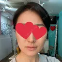 ハイフ（顔） 池袋麗歯科・美容皮膚科 DAY 1 サムネイル用