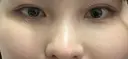 下まぶたの脂肪取り 品川美容外科 仙台院 AFTER サムネイル用