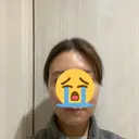 脂肪吸引（顔） ヴェルトラクリニック 大阪院 DAY 7 サムネイル用