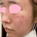 シミ取りレーザー UB CLINIC銀座 DAY 1 サムネイル用