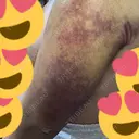 脂肪吸引（二の腕） 湘南美容クリニック 新潟院 DAY 10 サムネイル用