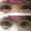 二重埋没 / 上まぶたの脂肪取り 東京ヒルズクリニック 新宿院 DAY 62 サムネイル用