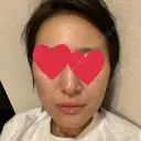 ハイフ（顔） 池袋麗歯科・美容皮膚科 DAY 5 サムネイル用
