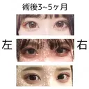二重埋没 共立美容外科 大宮院 DAY 151 サムネイル用