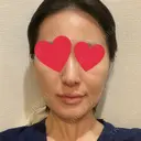 ハイフ（顔） 池袋麗歯科・美容皮膚科 DAY 6 サムネイル用