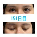 上まぶたの脂肪取り / 眉下切開 JUN CLINIC DAY 151 サムネイル用