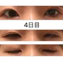 二重埋没 高須クリニック 大阪院 DAY 4 サムネイル用