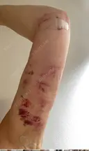 脂肪吸引（二の腕） 石倉クリニック 水戸院 DAY 1 サムネイル用