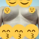 その他（胸） クリニックビューティー恵比寿 DAY 237 サムネイル用