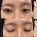 クマ治療 / 下まぶたたるみ取り セオリークリニック DAY 59 サムネイル用