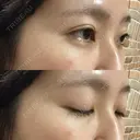クマ治療 / 下まぶたたるみ取り セオリークリニック DAY 59 サムネイル用