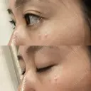 クマ治療 / 下まぶたたるみ取り セオリークリニック DAY 59 サムネイル用