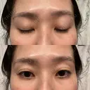 クマ治療 / 下まぶたたるみ取り セオリークリニック AFTER サムネイル用