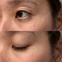 クマ治療 / 下まぶたたるみ取り セオリークリニック DAY 91 サムネイル用