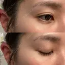 クマ治療 / 下まぶたたるみ取り セオリークリニック DAY 91 サムネイル用