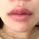 ヒアルロン酸注入（唇） / ボトックス（口角） アクトリー勝どきウェルネスメディカルクリニック DAY 21 サムネイル用
