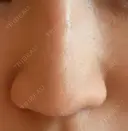 ヒアルロン酸注入（鼻） 新宿ビューティークリニック 新宿院 DAY 4 サムネイル用