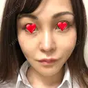 隆鼻術 / 鼻尖形成（切開） / 鼻中隔延長（切開） / 軟骨移植 / プロテーゼ除去 / 鼻修正 THE ROPPONGI CLINIC（ザ 六本木クリニック） DAY 49 サムネイル用