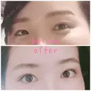 二重埋没 / 目頭切開 目白ポセンシアクリニック AFTER サムネイル用