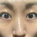 クマ治療 / 脂肪注入（肌） MIL CLINIC OSAKA DAY 19 サムネイル用
