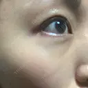クマ治療 / 脂肪注入（肌） MIL CLINIC OSAKA DAY 19 サムネイル用
