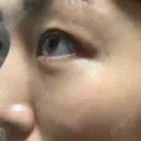 クマ治療 / 脂肪注入（肌） MIL CLINIC OSAKA DAY 19 サムネイル用