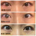 クマ治療 / 脂肪注入（肌） MIL CLINIC OSAKA DAY 20 サムネイル用