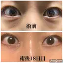 クマ治療 / 脂肪注入（肌） MIL CLINIC OSAKA DAY 20 サムネイル用