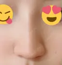 ヒアルロン酸注入（鼻） 新宿ビューティークリニック 新宿院 DAY 6 サムネイル用