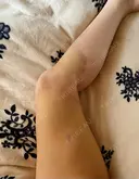 脂肪吸引（脚） / 豊胸（脂肪注入） 石倉クリニック 水戸院 DAY 5 サムネイル用