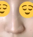 ヒアルロン酸注入（鼻） 新宿ビューティークリニック 新宿院 DAY 7 サムネイル用