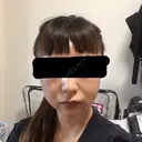 脂肪吸引（顔） / その他（輪郭） / 脂肪注入（輪郭） ヴィヴェンシアクリニック DAY 20 サムネイル用