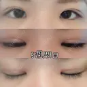 目頭切開 / 眼瞼下垂（切開） 白山クリニック 大分 AFTER サムネイル用