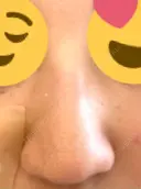 ヒアルロン酸注入（鼻） 新宿ビューティークリニック 新宿院 DAY 9 サムネイル用