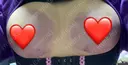 豊胸（脂肪注入） 湘南美容クリニック 新潟院 DAY 0 サムネイル用