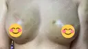 豊胸（脂肪注入） 湘南美容クリニック 新潟院 DAY 7 サムネイル用