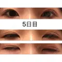 二重埋没 高須クリニック 大阪院 DAY 5 サムネイル用