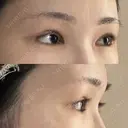 二重切開 / 目頭切開 / 眼瞼下垂（切開） / 上まぶたの脂肪取り 銀座マイアミ美容外科 DAY 93 サムネイル用