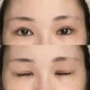 二重切開 / 目頭切開 / 眼瞼下垂（切開） / 上まぶたの脂肪取り 銀座マイアミ美容外科 DAY 93 サムネイル用