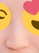 ヒアルロン酸注入（鼻） 新宿ビューティークリニック 新宿院 DAY 11 サムネイル用